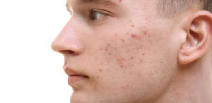 tratamiento del acne