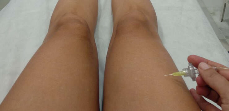 Beneficios de la Carboxiterapia