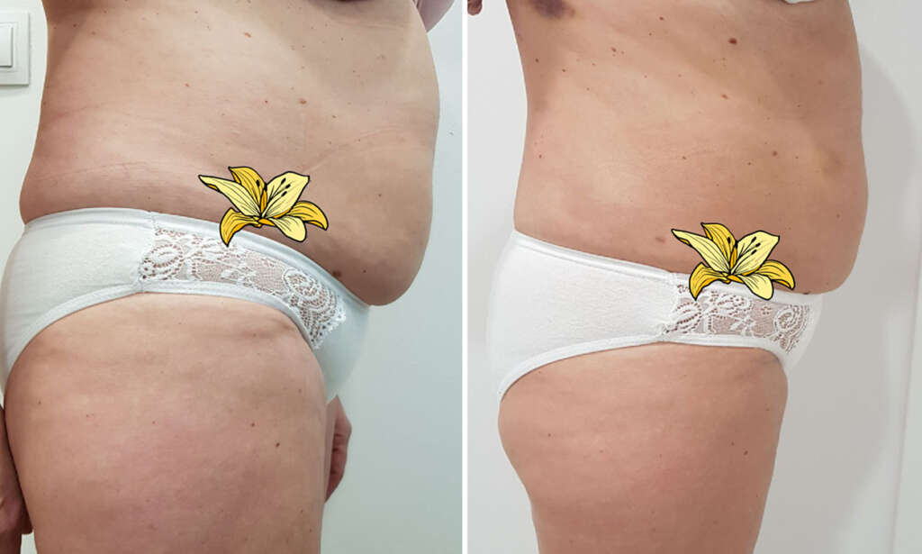 combatir la celulitis