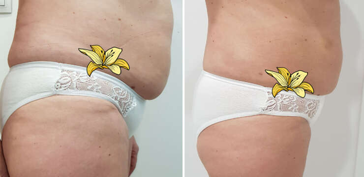 combatir la celulitis